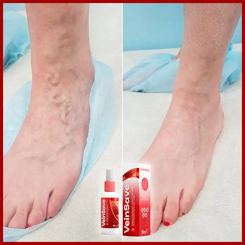 VeinSave відгук 2